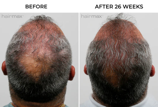 Hairmax - PowerFlex Laser Cap 272-Maximum Hair Growth Performance