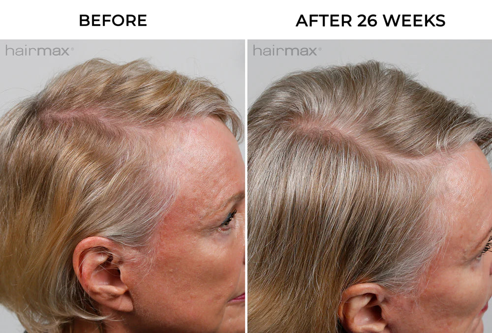 Hairmax - PowerFlex Laser Cap 272-Maximum Hair Growth Performance