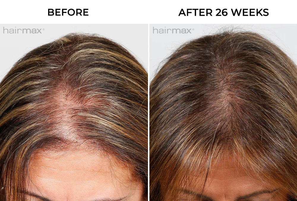 Hairmax - PowerFlex Laser Cap 272-Maximum Hair Growth Performance
