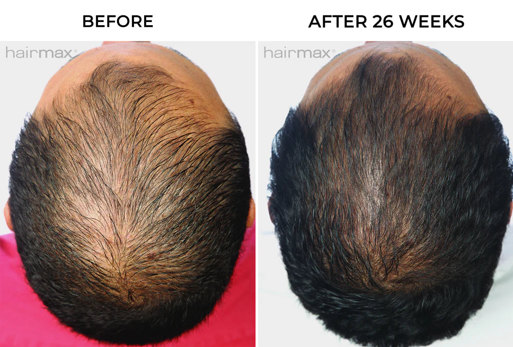 Hairmax - PowerFlex Laser Cap 272-Maximum Hair Growth Performance