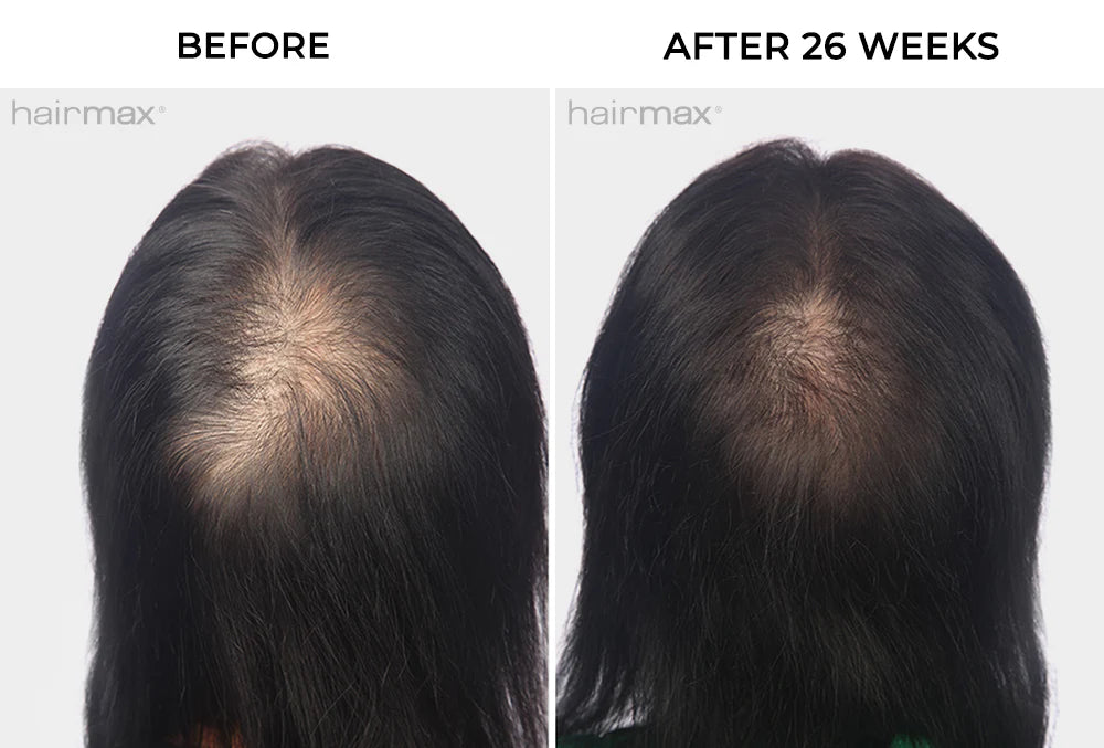Hairmax - Laser Band 82-Advanced Laser Therapy for Hair Regrowth