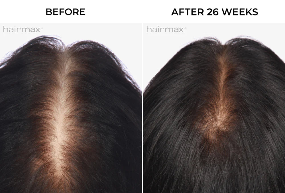 Hairmax - Laser Band 82-Advanced Laser Therapy for Hair Regrowth