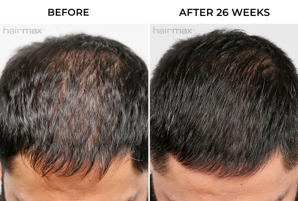 Hairmax - Laser Band 82-Advanced Laser Therapy for Hair Regrowth