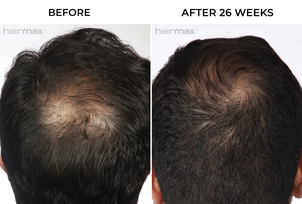 Hairmax - Laser Band 82-Advanced Laser Therapy for Hair Regrowth