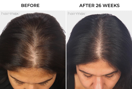 Hairmax - Ultima Classic Laser Comb-Advanced Laser Hair Restoration